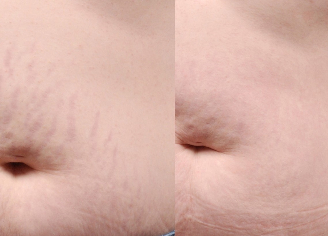 Stretch-Mark-Before--After-4_(2)