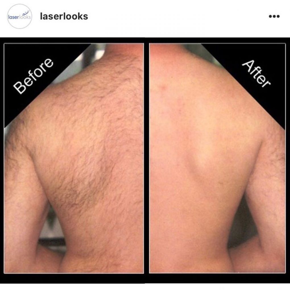 hair_removal_men_photo_website