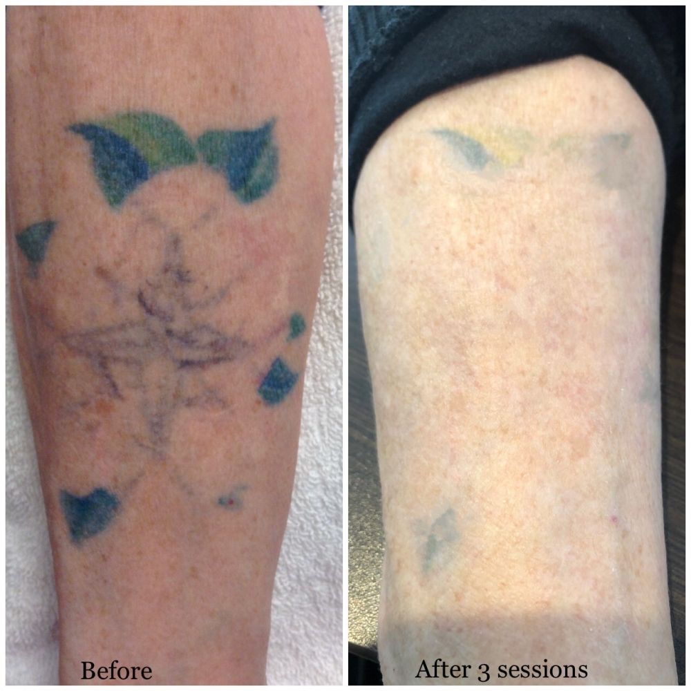 tattoo_removal_2