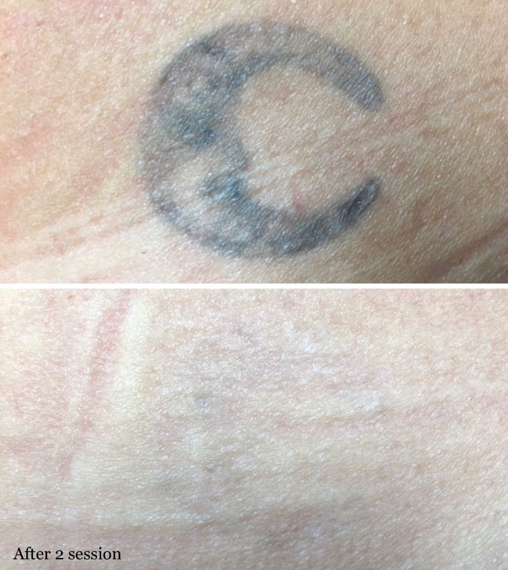 tattoo_removal_1